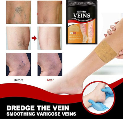 Varicose Veins Relief Patch – Improve Blood Circulation, Reduce Swelling & Pain | Natural Leg Care Solution