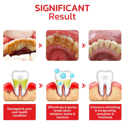 SP4 Teeth Whitening (Buy 1 Get 1 Free)